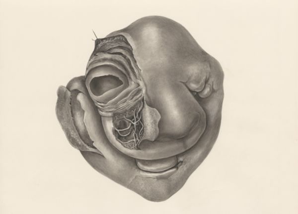 H.G Wetselaar, Deformed fetal head, seen from the front
