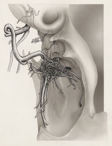 J Tinkelenberg, Nerves and other tissue of the neck and/or head