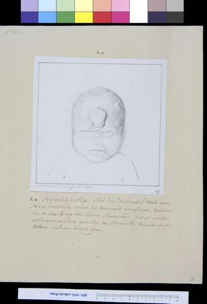 M Houtman, Child with deformed head