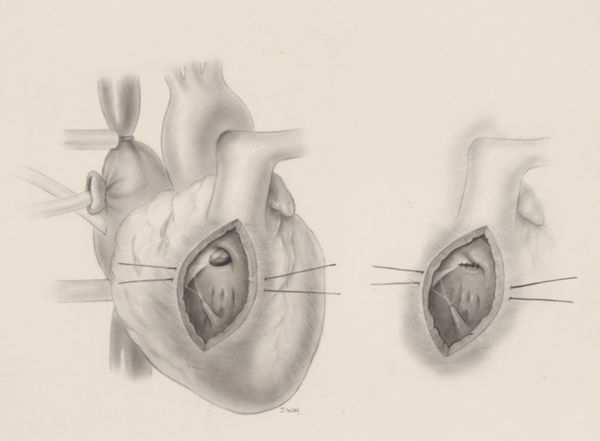 J Wetselaar-Whittaker, Ventricular septal