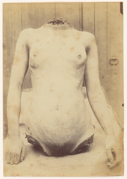 Alphonse Bertillon, Vue de face du Tronc