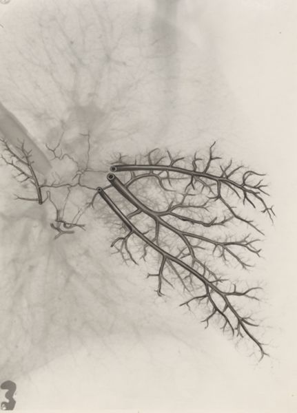 J Tinkelenberg, Bronchi