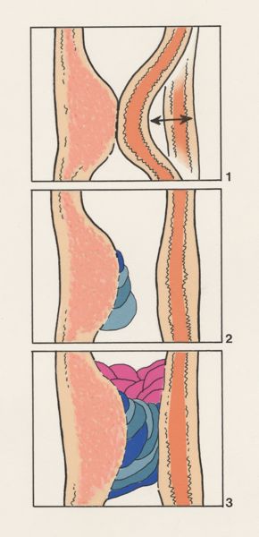 J Tinkelenberg, Part of the heart and circulatory system