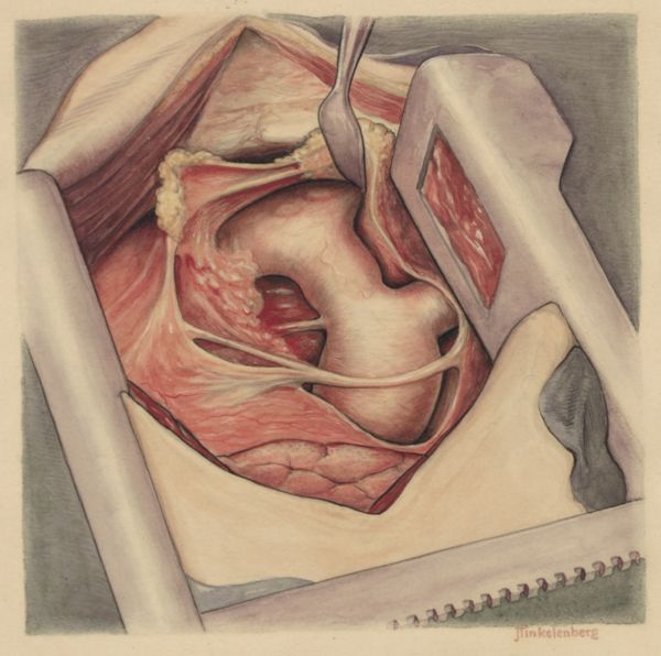 J Tinkelenberg, Thorax surgery