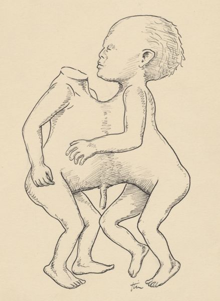J Tinkelenberg, Conjoined twins