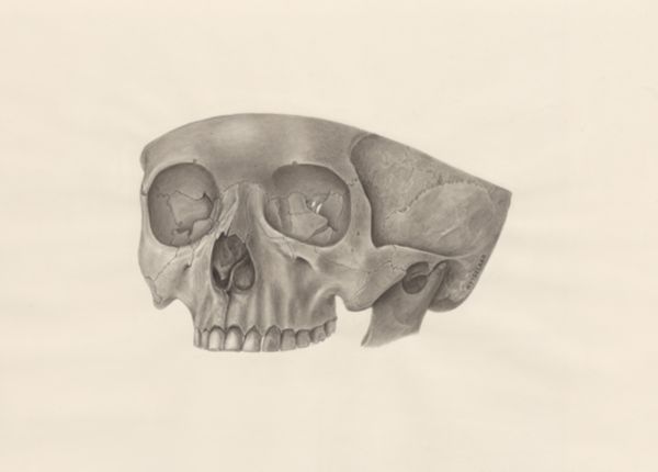 H.G Wetselaar, Deformed fetal skull