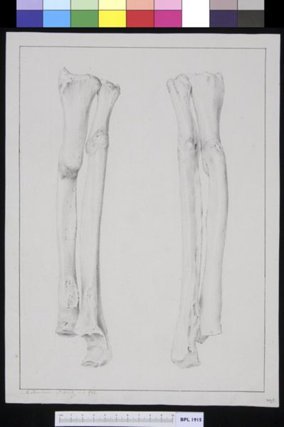 M Houtman, Tibia and fibula
