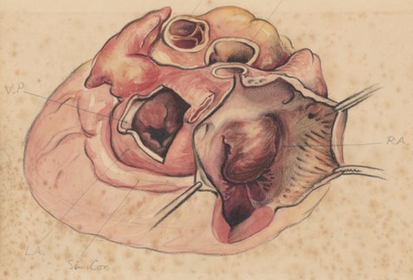J Tinkelenberg, Heart