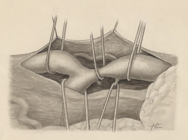 J Tinkelenberg, Heart and adjacent organs