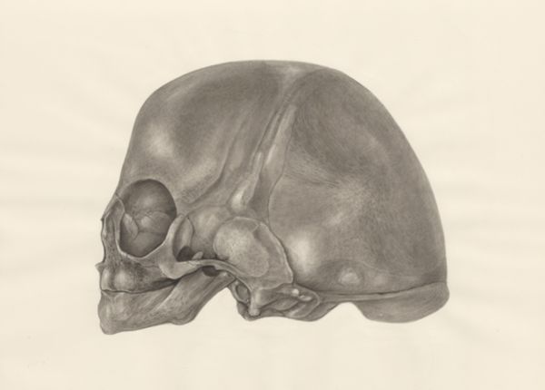 H.G Wetselaar, Deformed fetal skull