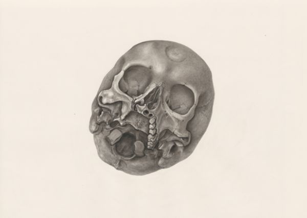 H.G Wetselaar, Deformed fetal skull