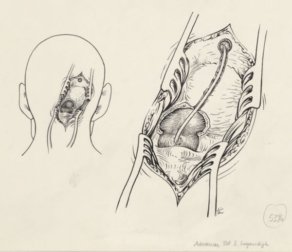 J Tinkelenberg, Neurosurgical Procedures