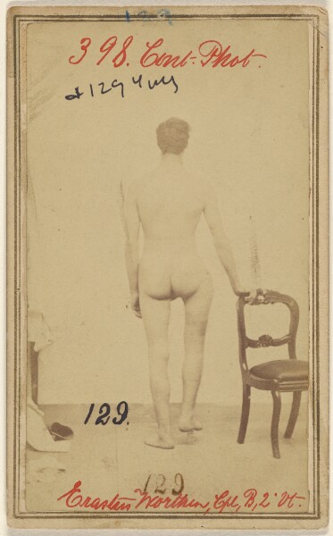 Unknown, Fracture of the upper third of the Femur. Erastus Worthen, Corp Co. B. 2nd Vermont Vols. aged 25 - Residence Stockbridge VT.