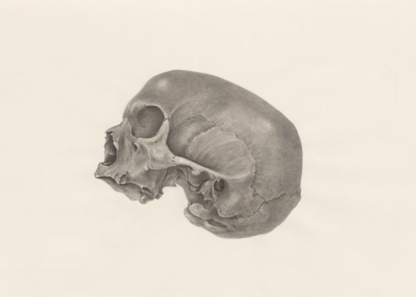 H.G Wetselaar, Deformed skull