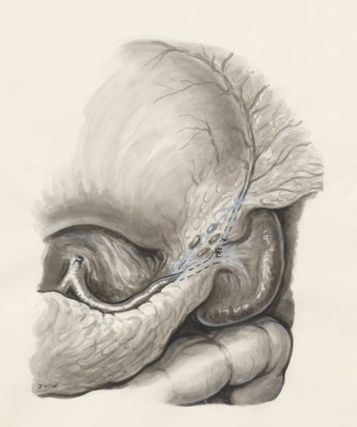 J Wetselaar-Whittaker, Surgery on a part of the human body