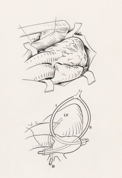 J Tinkelenberg, Thorax surgery