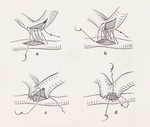 J Tinkelenberg, Thorax surgery