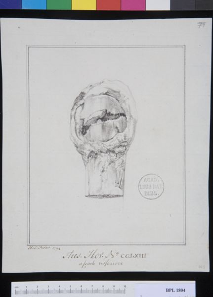 Poster, H.J, (active, Pathology, fractures (Patella)