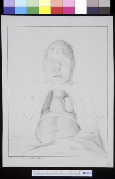 M. Houtman, Open abdomen of a woman who suffered an aneurysm