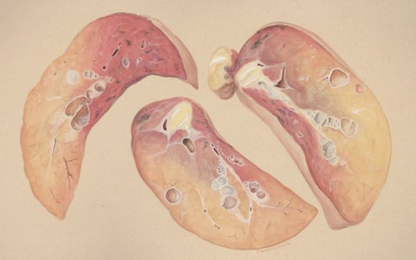 J Wetselaar-Whittaker, Lung tissue