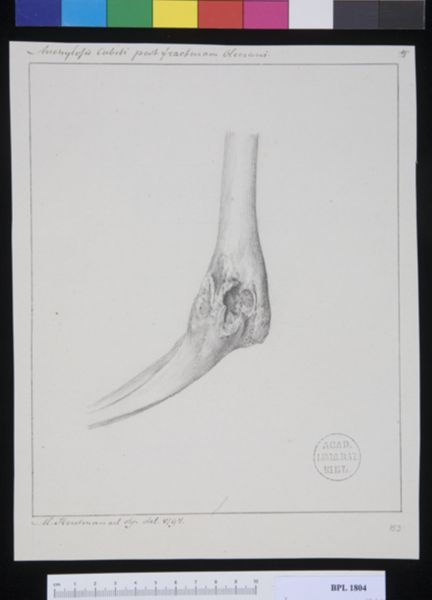 M. Houtman, Pathology, fractures (Ankylosis)