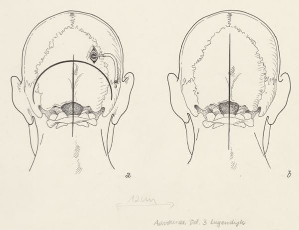 J Tinkelenberg, Neurosurgical Procedures