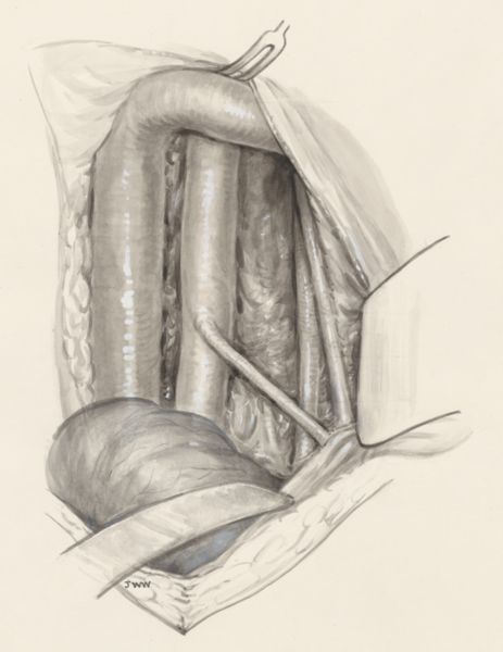J Wetselaar-Whittaker, Part of the human body, opened with medical clamps