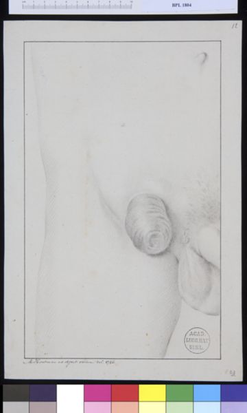 M Houtman, Pathology, fractures