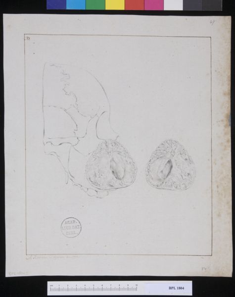 M Houtman, Pathology, fractures (Tumor from a woman's cheek)