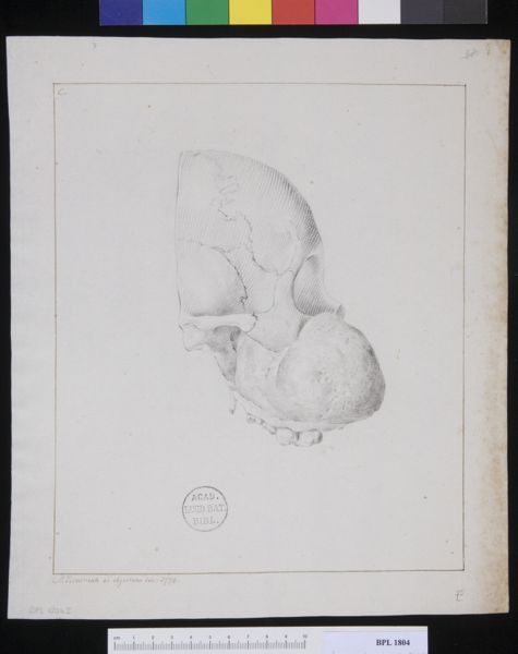 M Houtman, Pathology, fractures (Tumor from a woman's cheek)