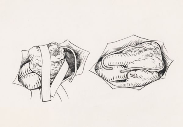 J Tinkelenberg, Thorax surgery