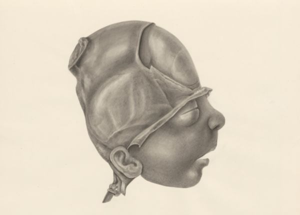 H.G Wetselaar, Deformed fetal head