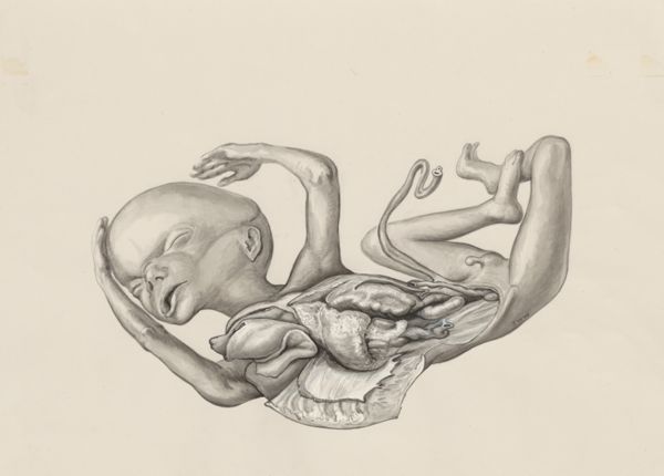 J Wetselaar-Whittaker, Fetus with open abdominal cavity