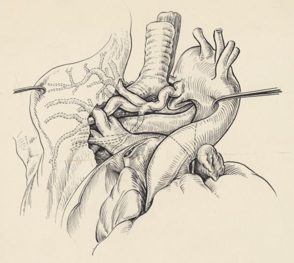 J Tinkelenberg, Part of the heart and circulatory system