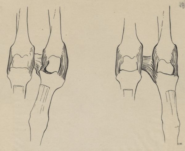J Wetselaar-Whittaker, Two sets of finger joints