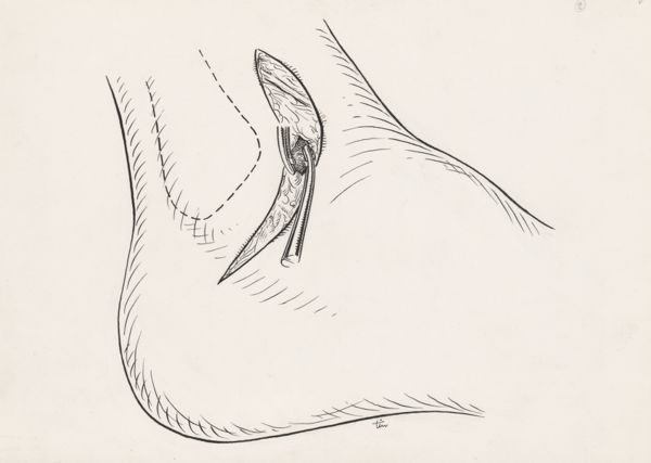J Tinkelenberg, Surgery of the ankle ligament