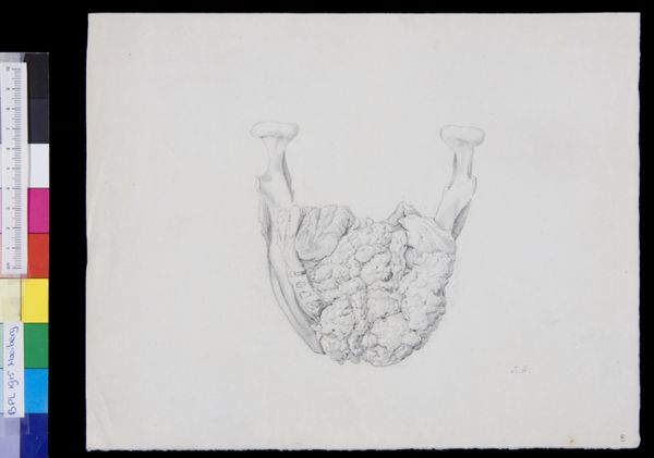 Tiemen Hooiberg, Pathology, skull, lower jaw