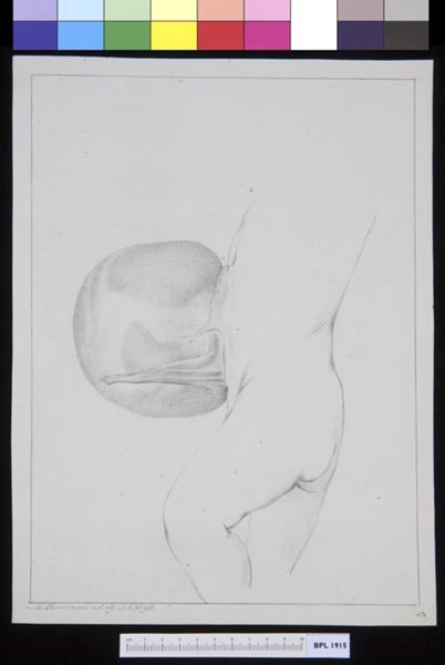 M Houtman, Hernia on a child's body