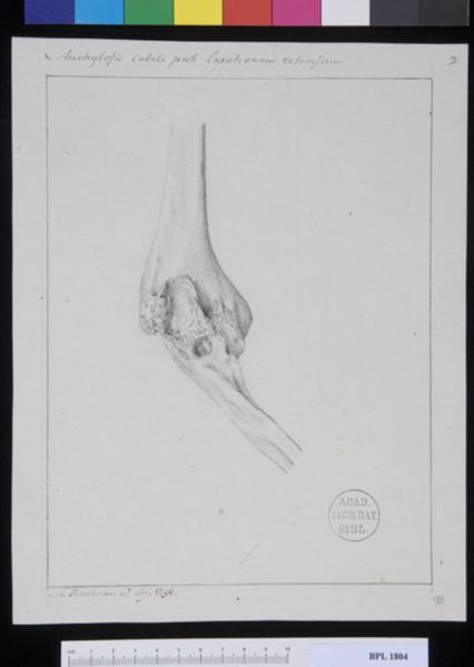 M. Houtman, Pathology, fractures (Ankylosis)