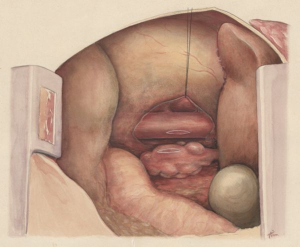J Tinkelenberg, Heart surgery