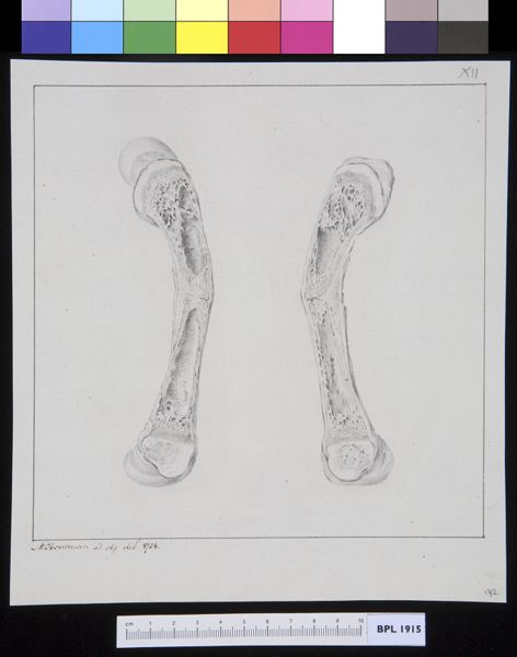M Houtman, Infected bone, cross section