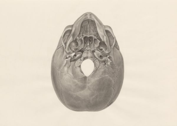 H.G Wetselaar, Deformed fetal skull, seen from below