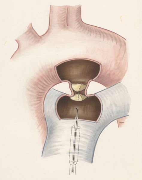 J Wetselaar-Whittaker, Procedure to open the artery around the heart of young children, devised by Dr. J. Rohmer
