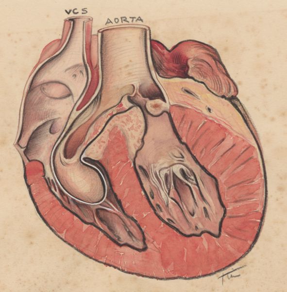 J Tinkelenberg, Cross section of the heart