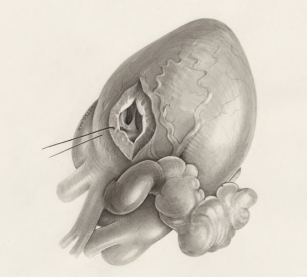 H.G Wetselaar, Heart