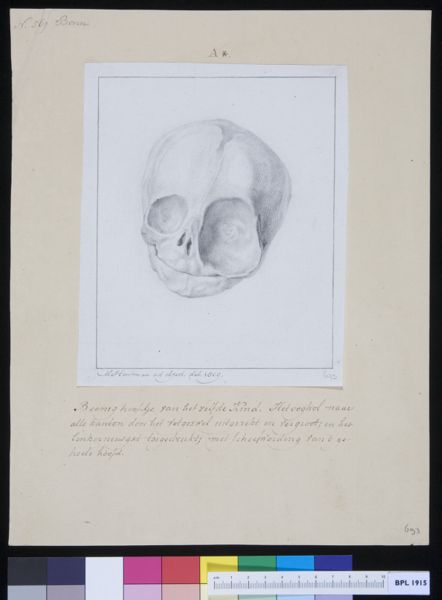 M Houtman, Skull of a child with enlarged eye socket