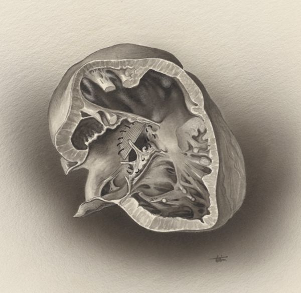 J Tinkelenberg, Heart