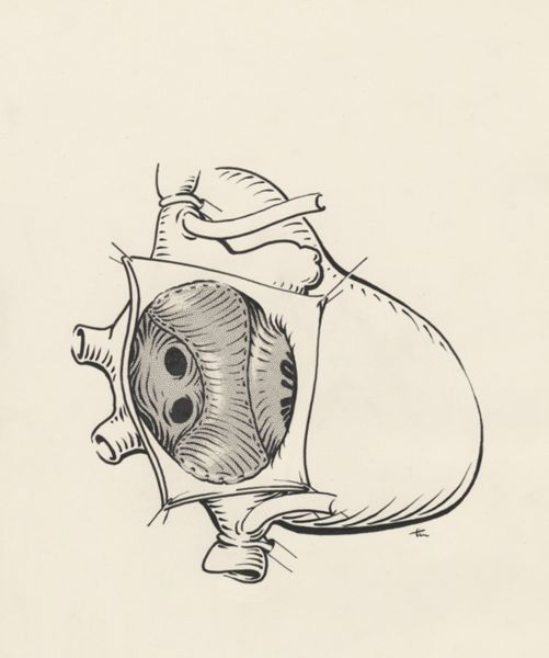 J Tinkelenberg, Heart surgery