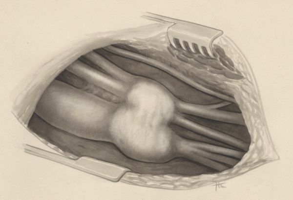 J Tinkelenberg, Circulatory system