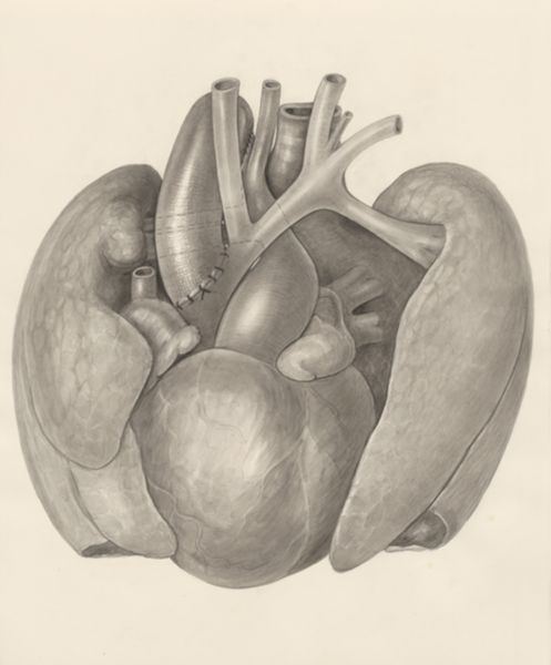 H.G Wetselaar, Surgical procedure on a heart and adjacent organs